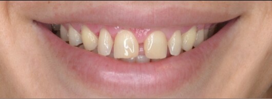 Antes diseño de sonrisa